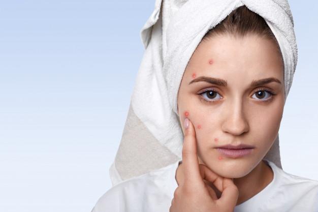 Portrait of young woman having problem skin and pimple on her cheek, wearing towel on her head having sad expression pointing Free Photo